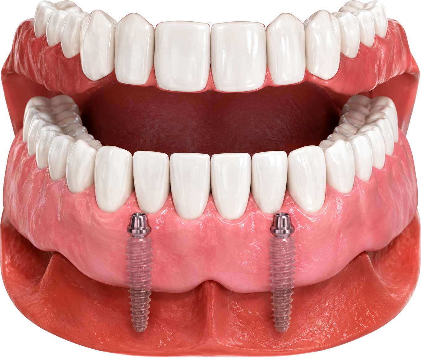 Implant-Supported Dentures: A Secure, Comfortable Solution for Missing Teeth