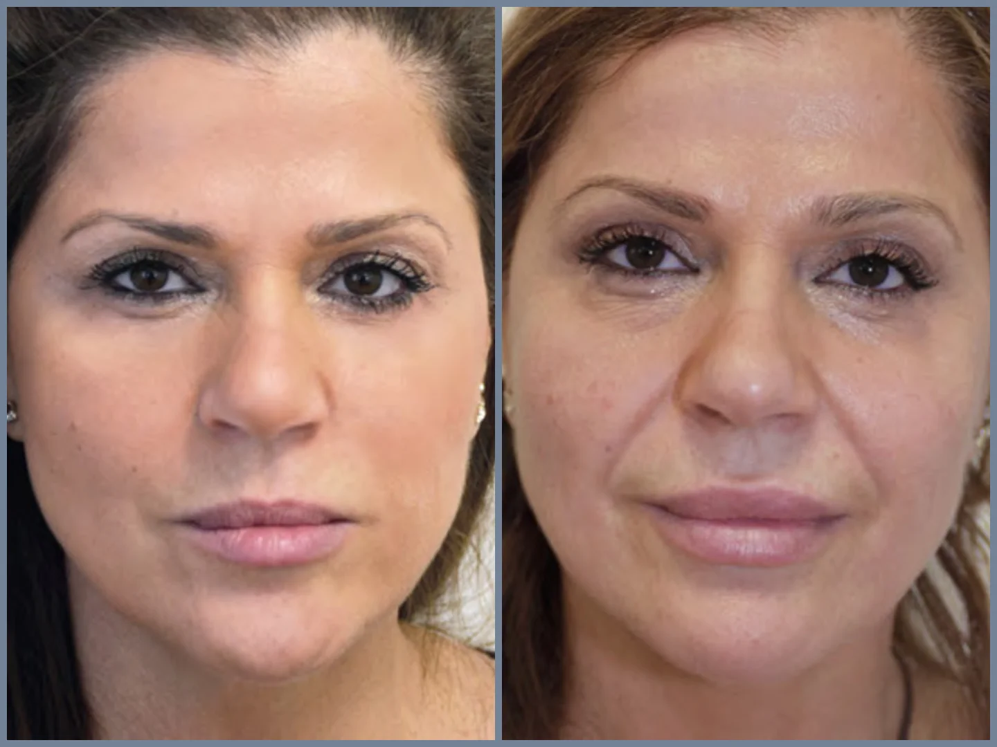 Reverse Gravity with a Thread Lift Facelift Procedure